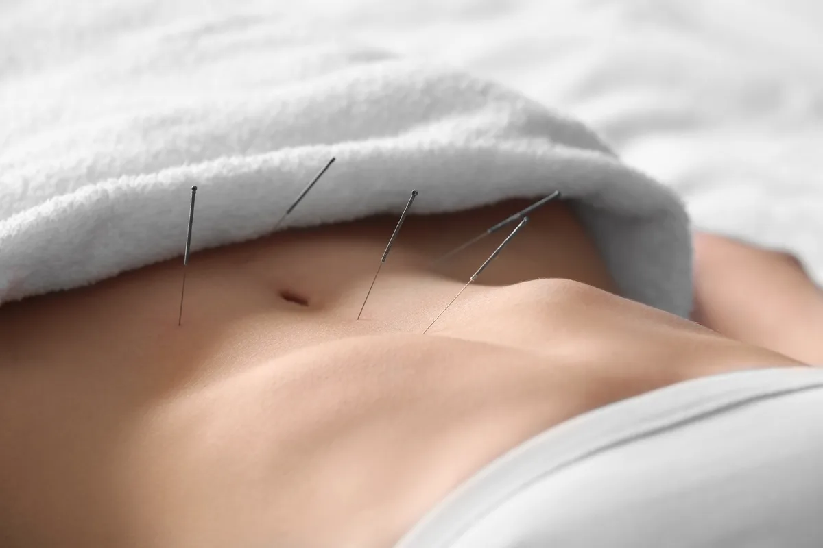 Feine Akupunkturnadeln am Bauch einer liegenden Patientin